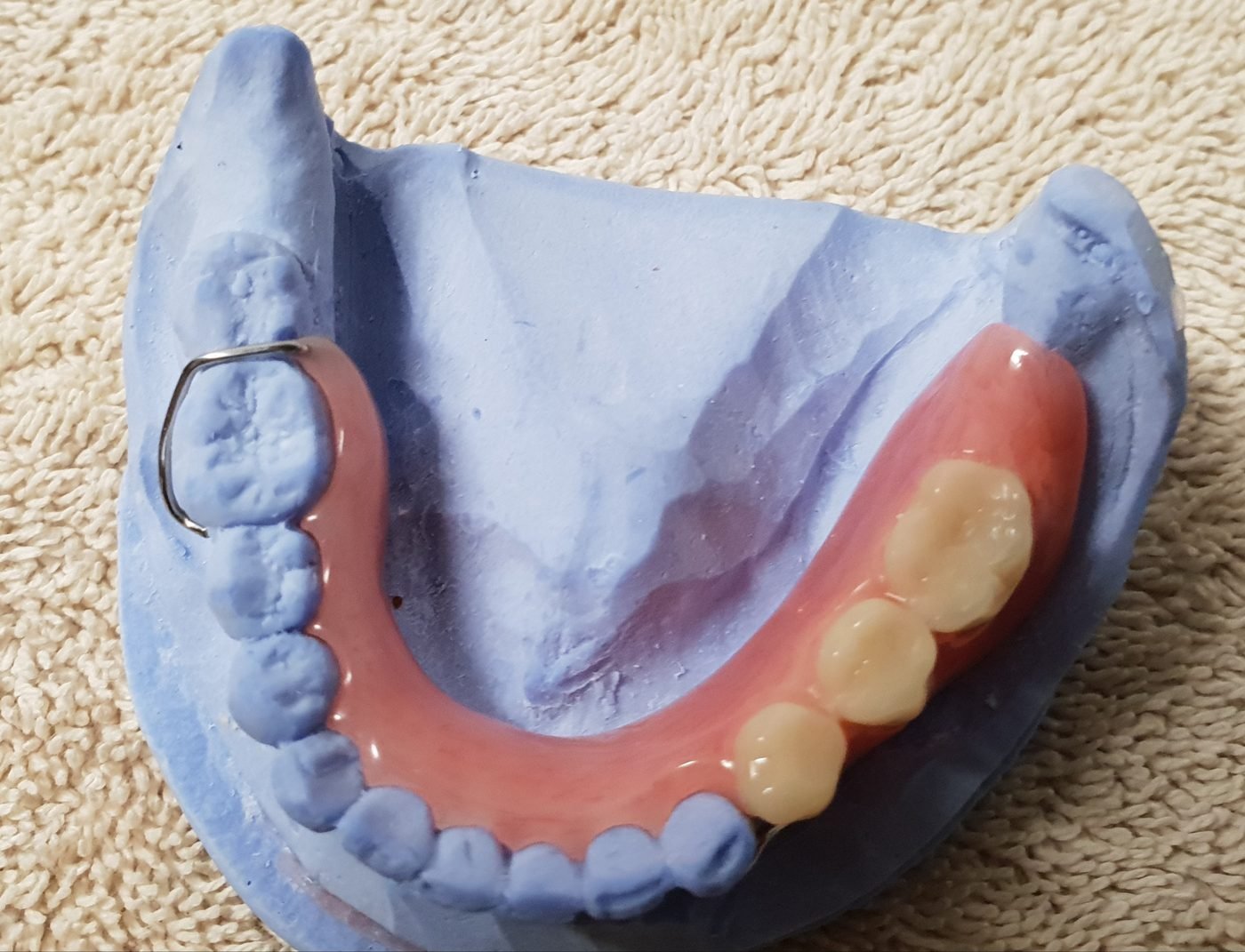 Partial denture crafted on a dental model